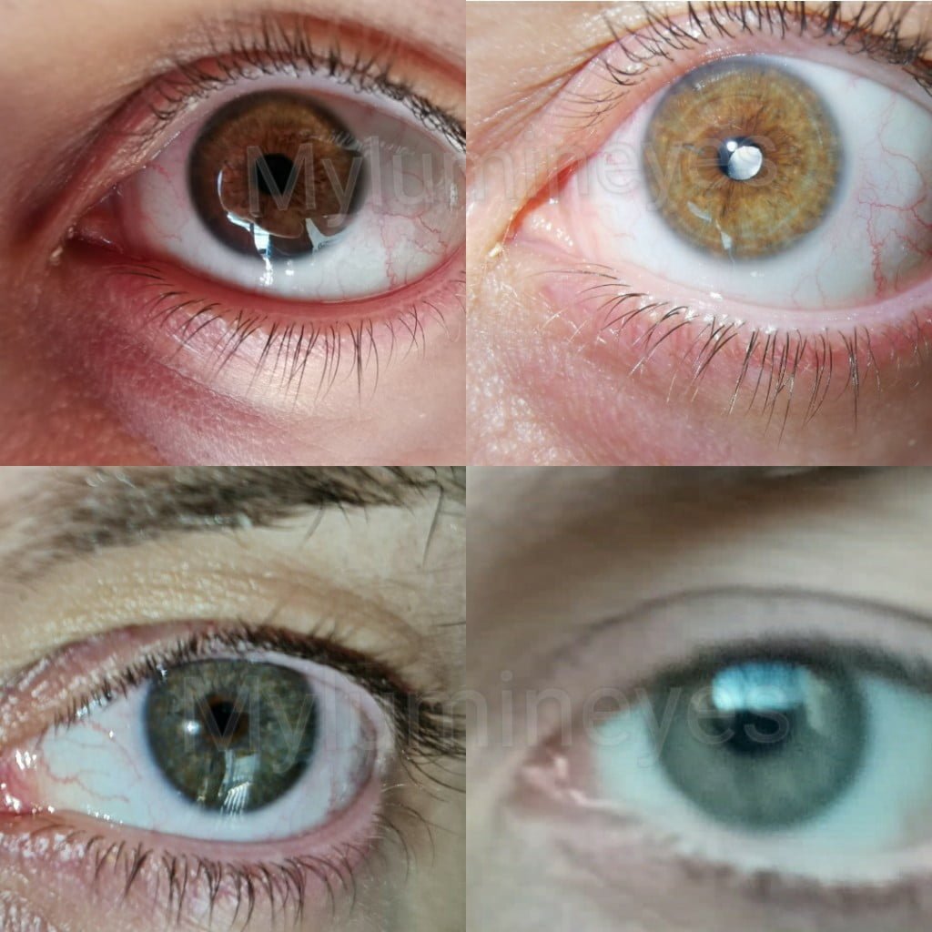 Eye Color Changing Surgery Methods