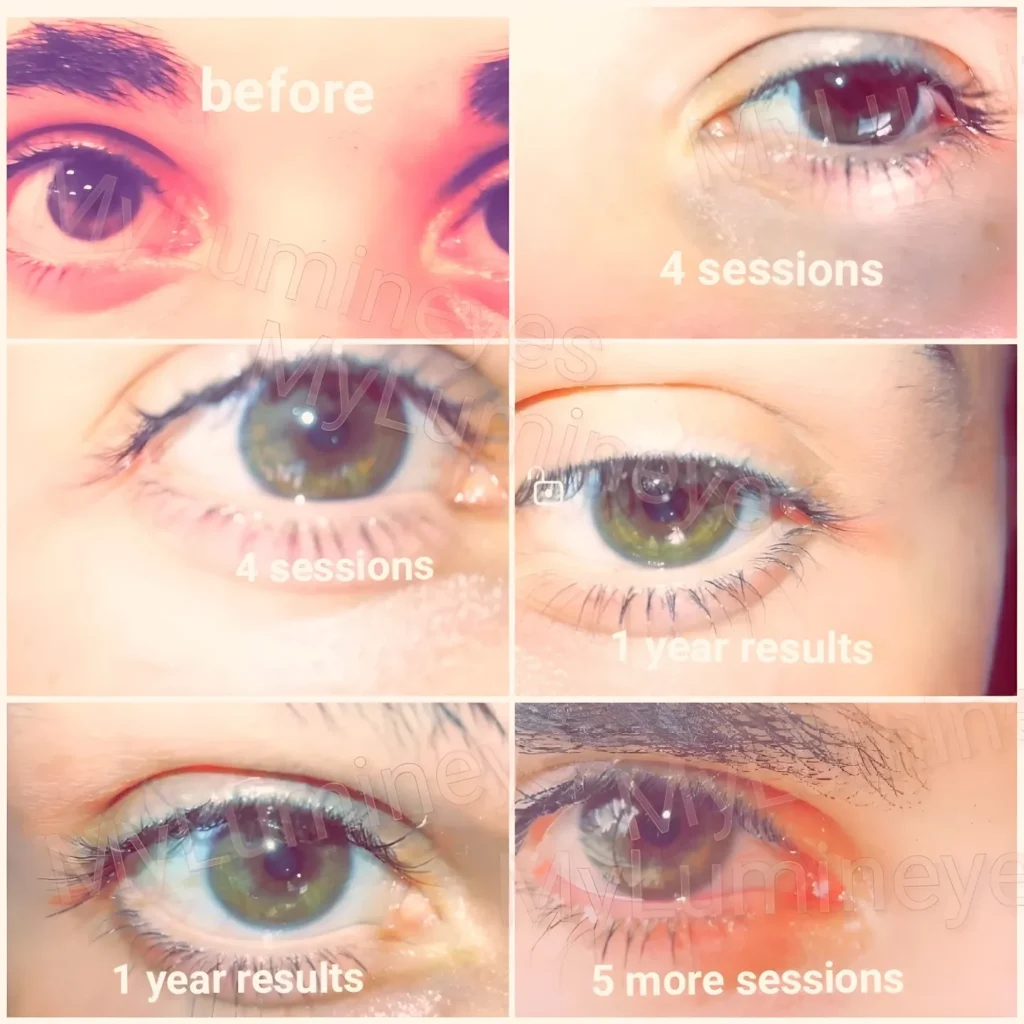 changing eye color surgery