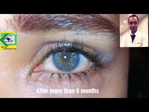 changing your eye color by laser surgery