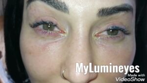 Video Thumbnail: Eye Color Change Surgery Turkey Permanently