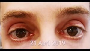 eye color change surgery turkey 1 3