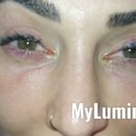 Eye color laser surgery Cost and Guide 10 eye color change surgery turkey 1 31
