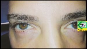 is laser eye color change surger 1