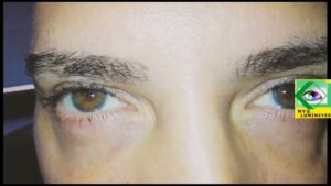 Video Thumbnail: Is laser eye color change surgery safe? #safe #lasereyecolorchange #eyecolorchange #changeyecolor