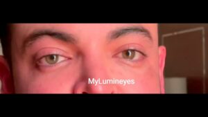 Video Thumbnail: Laser eye color change surgery before and after #beforeandafter #lasereyecolorchange