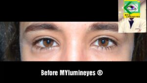 Video Thumbnail: Laser Eye Color Change Surgery Procedure brown to amazing blue eyes !