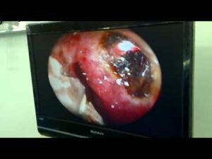 multidiod transkanalikuler lazer 2