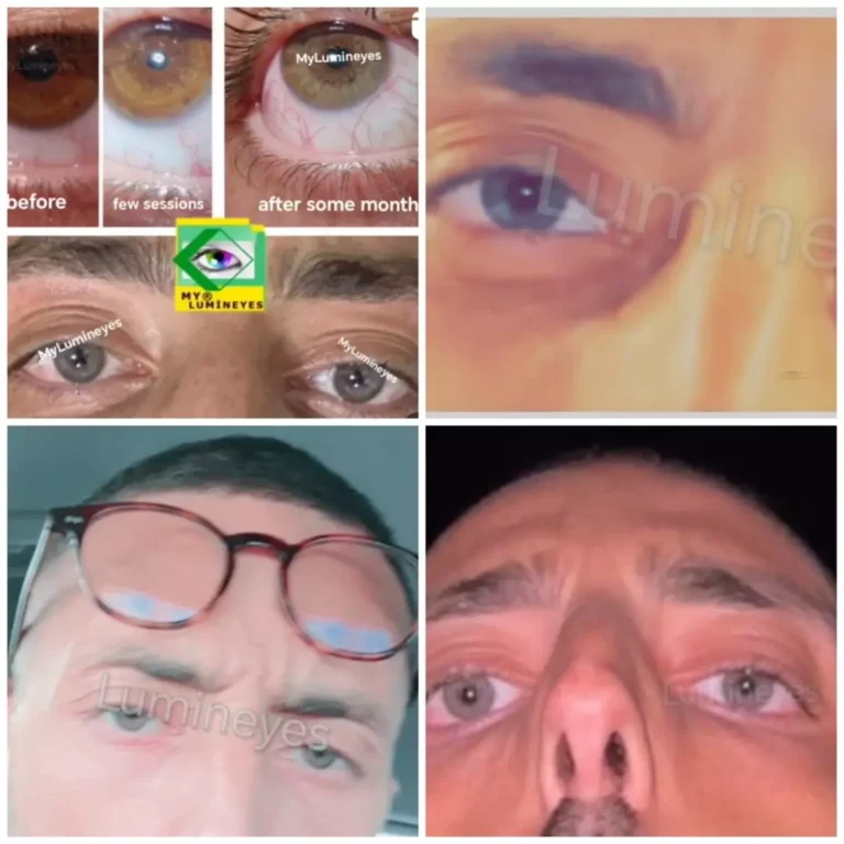 changing eye color and laser iris depigmentation