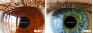 before after lumineyes