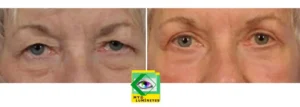 blepharoplasty istanbul cost