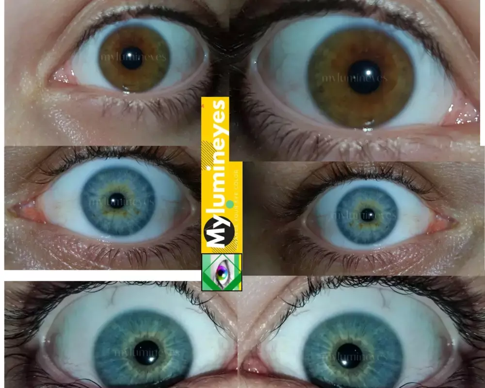 change eye color by laser
