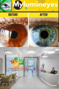 Laser eye color change procedure