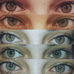 Post-Procedure at Lumineyes clinic