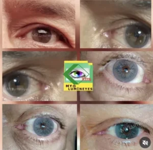 laser eye color change in progress using Lumineyes