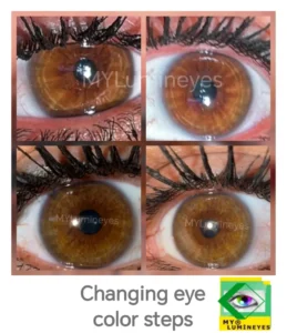 laser eye color surgery