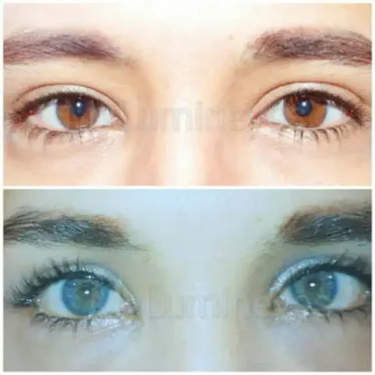 permanent laser eye color change before and after results by mylumineyes