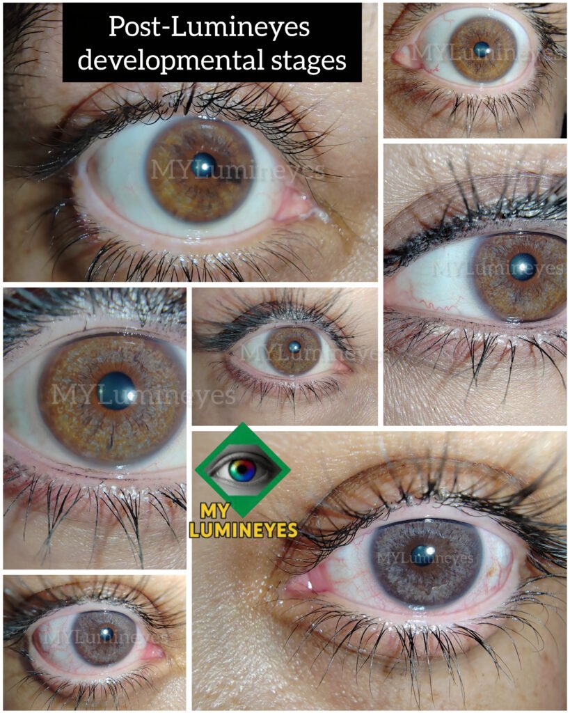 How to Change Eye Color with Laser