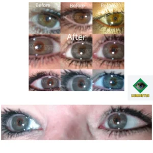eye color change surgery with laser