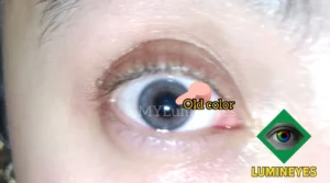 eye color surgery by laser lumineyes