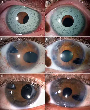 Eye color change surgery 1 eye color change surgery