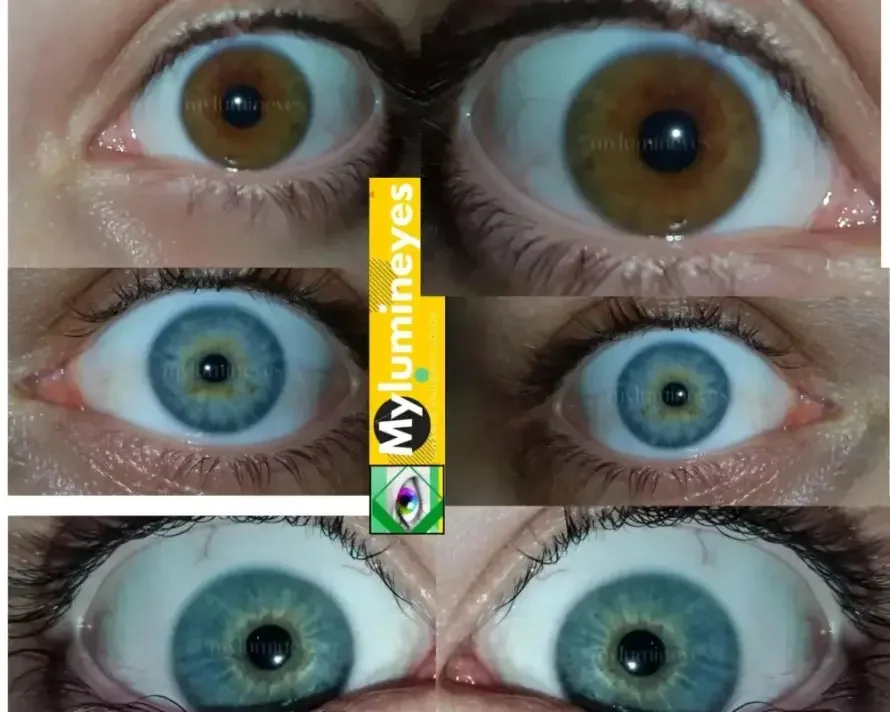 laser eye color change before and after in Turkey