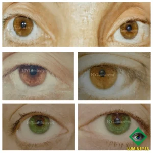 before-after laser eye color change mylumineyes