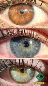 Clinical photo example after lumineyes treatment