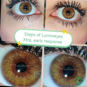 early response of eyes to lumineyes xtra treatment