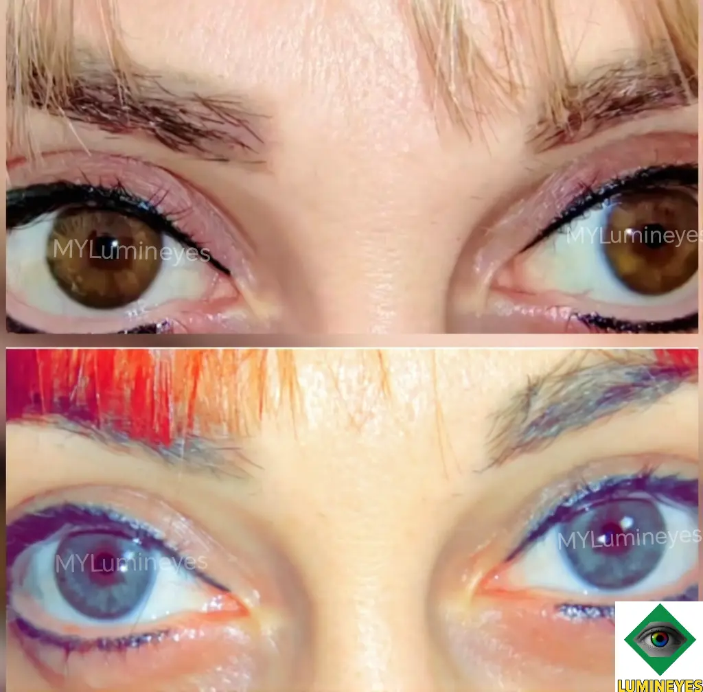 individual clinical outcome example following staged laser iris pigment lightening

