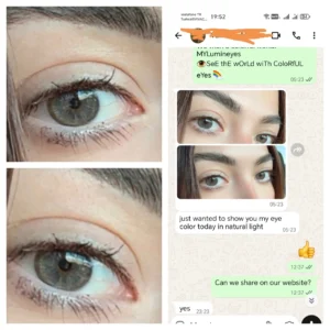 Laser eye color change procedure showing controlled iris depigmentation