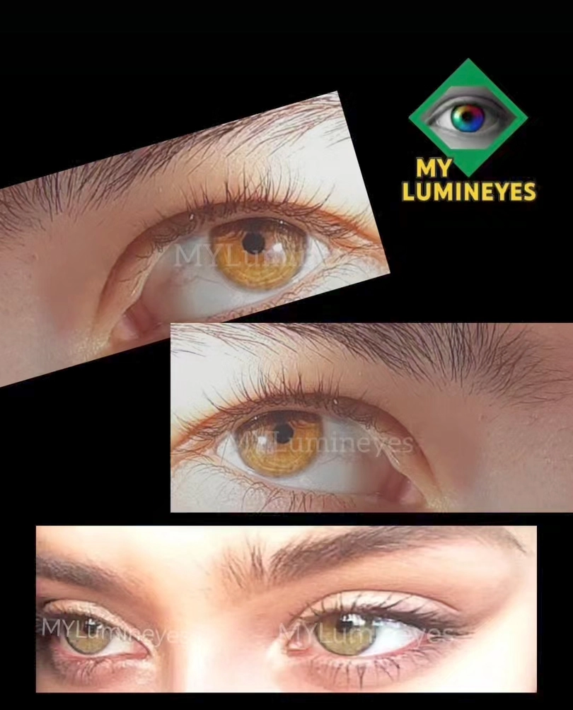 Laser eye color change recovery timeline showing post-procedure healing phases
