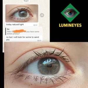 Selective laser iris depigmentation procedure for permanent eye color change – Lumineyes technique