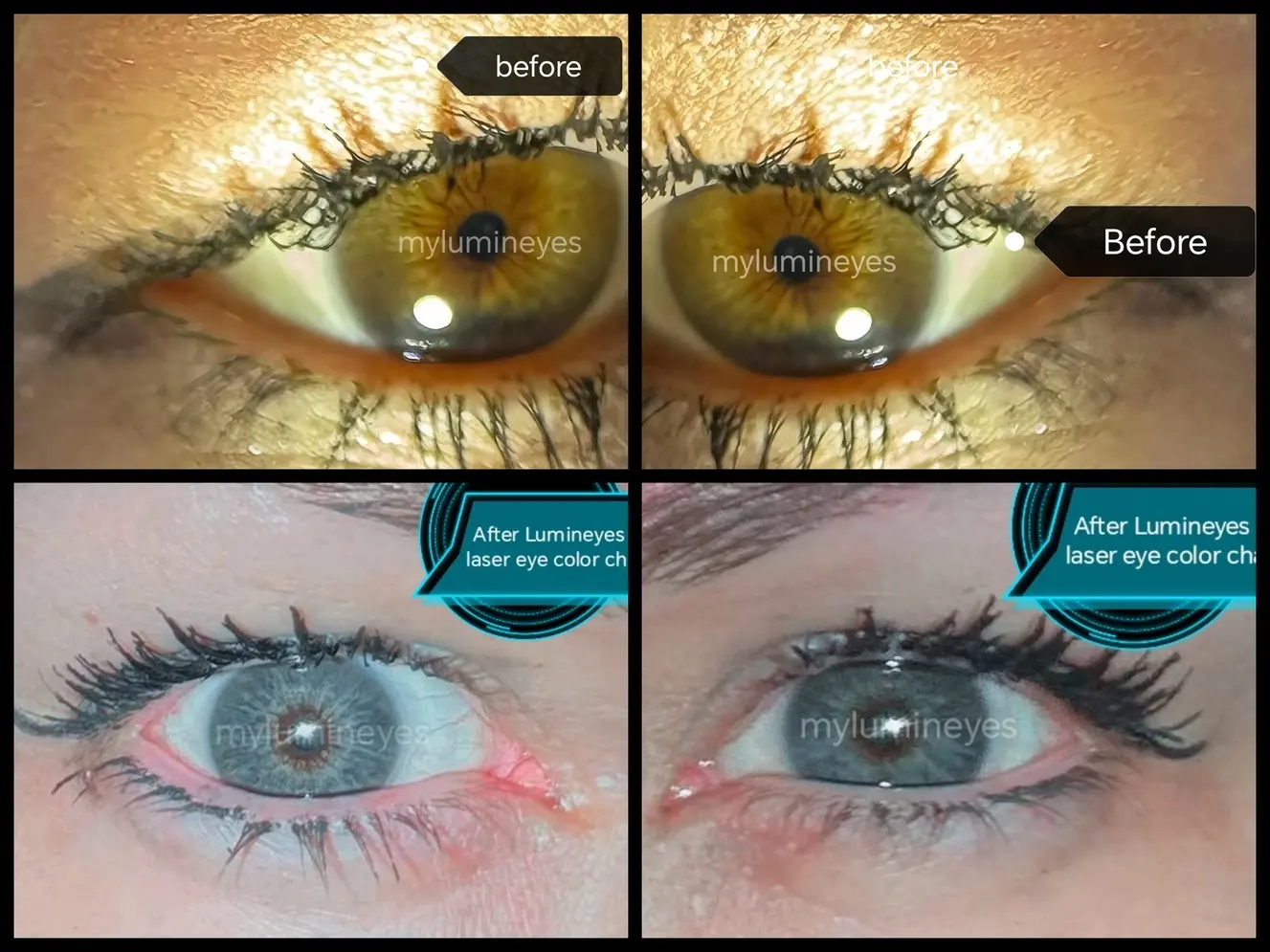 Laser iris depigmentation safety protocol in eye color change surgery