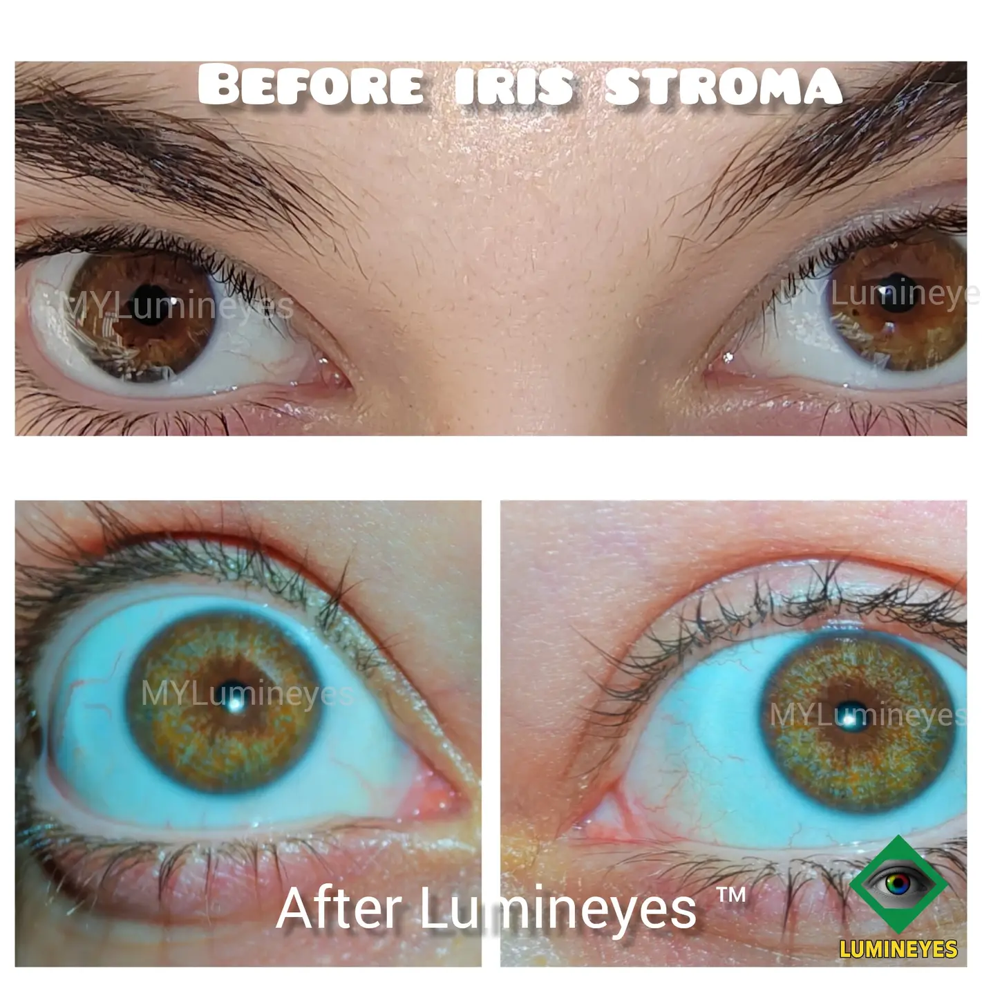 Technical analysis of iris stroma integrity and 15-year pigment stability after Lumineyes laser treatment