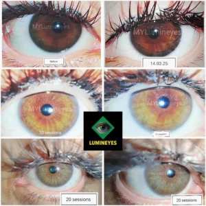 Gradual iris color transition after laser eye color change as fragmented pigment is naturally cleared through the aqueous humor