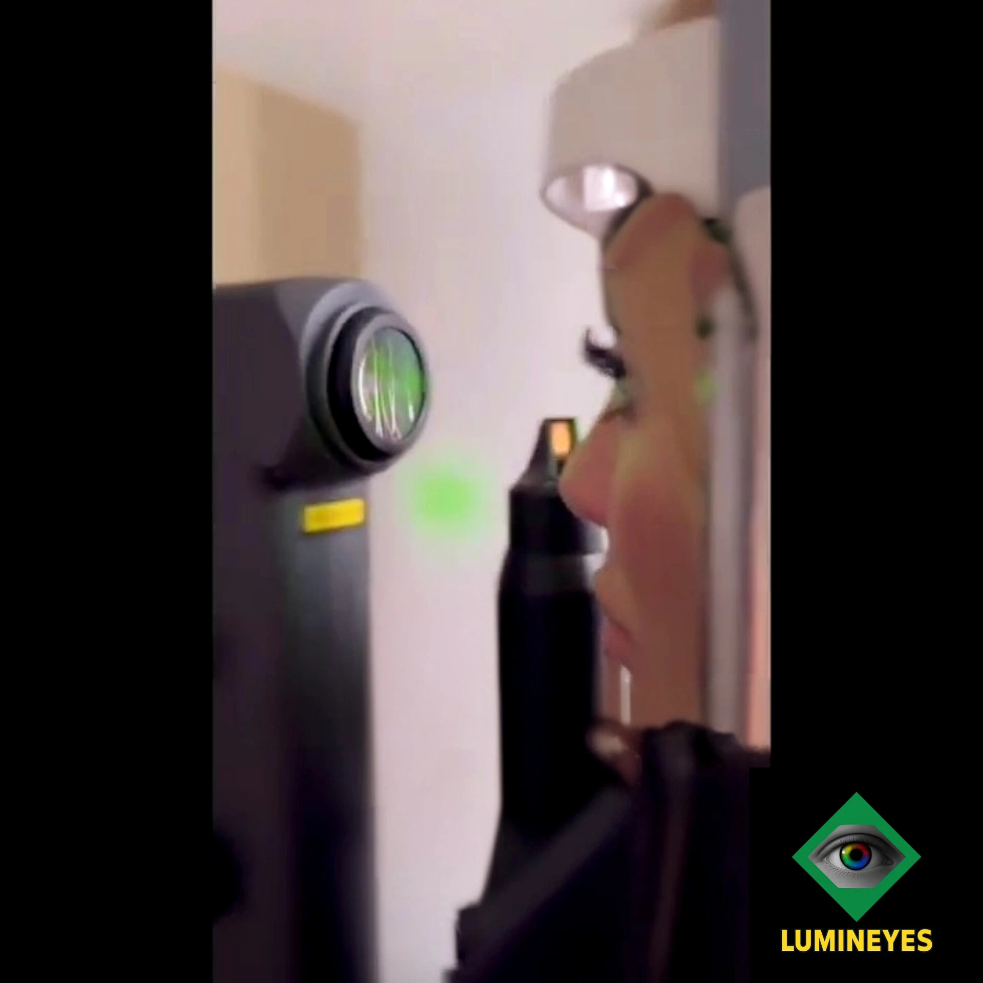 Mylumineyes laser application performed in staged sessions to lighten iris color without surgical incisions