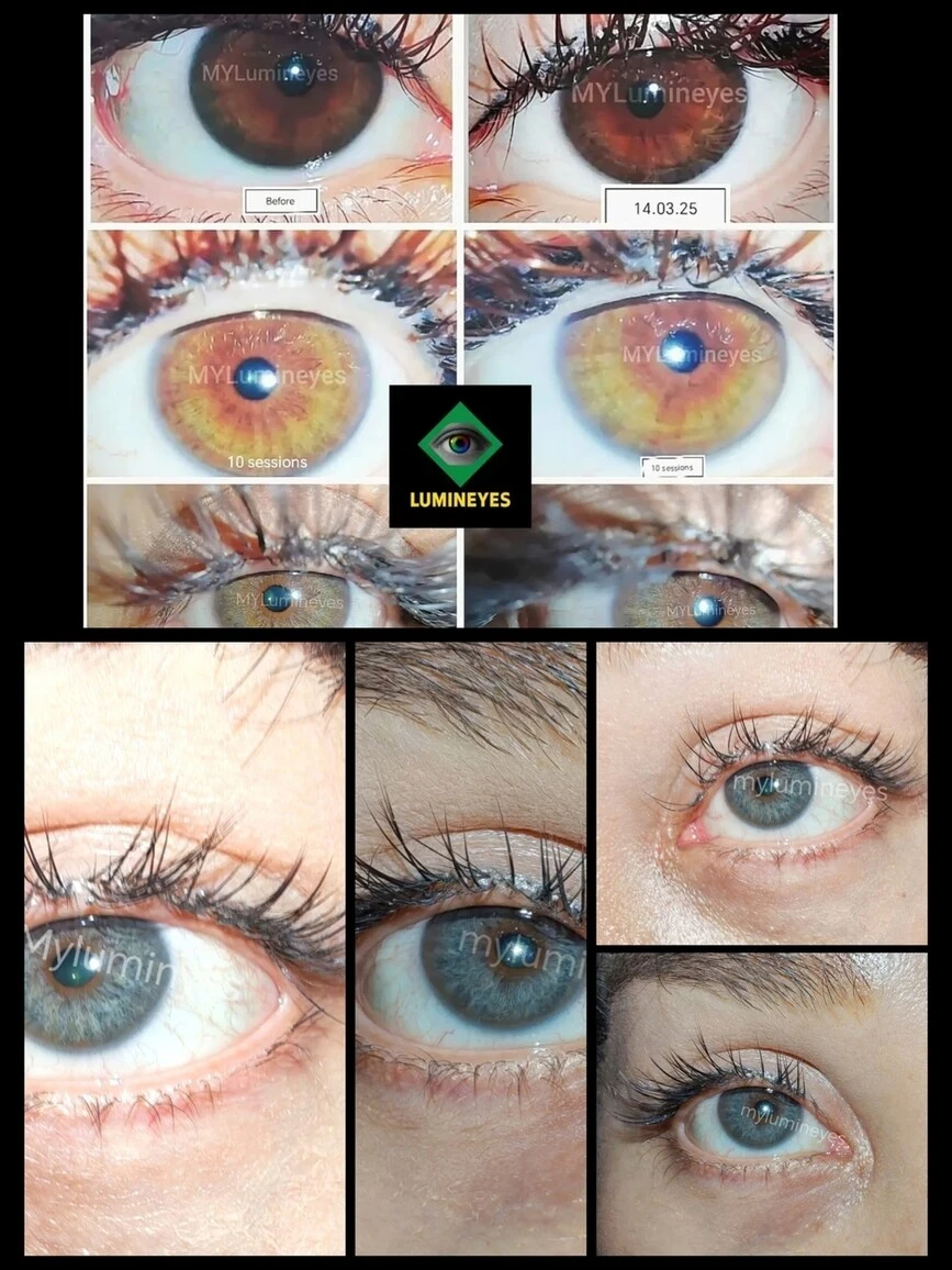 Laser eye color change results: Dark brown to natural blue transition by Dr. Mustafa Mete