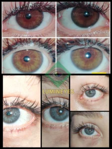 Before and after 2-year results of permanent laser eye color change from brown to blue using MyLumineyes technology.