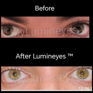 Before and after photos of a plastic surgeon in the United States. An example of professionals' trust in Myumineyes.