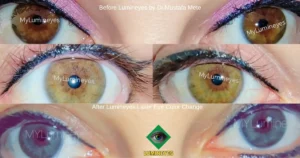 Close-up before and after photo of a patient undergoing safe laser iris depigmentation to change eye color from brown to green using the MyLumineyes protocol.