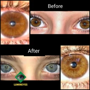 laser eye color change surgery clinical framework