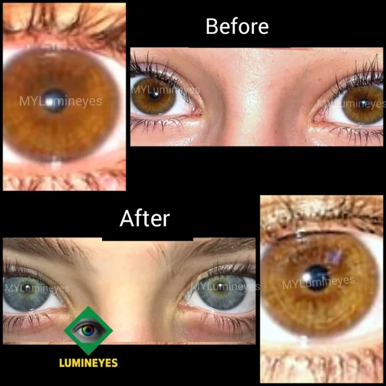 laser eye color change clinical framework explains how selective stromal melanin modulation