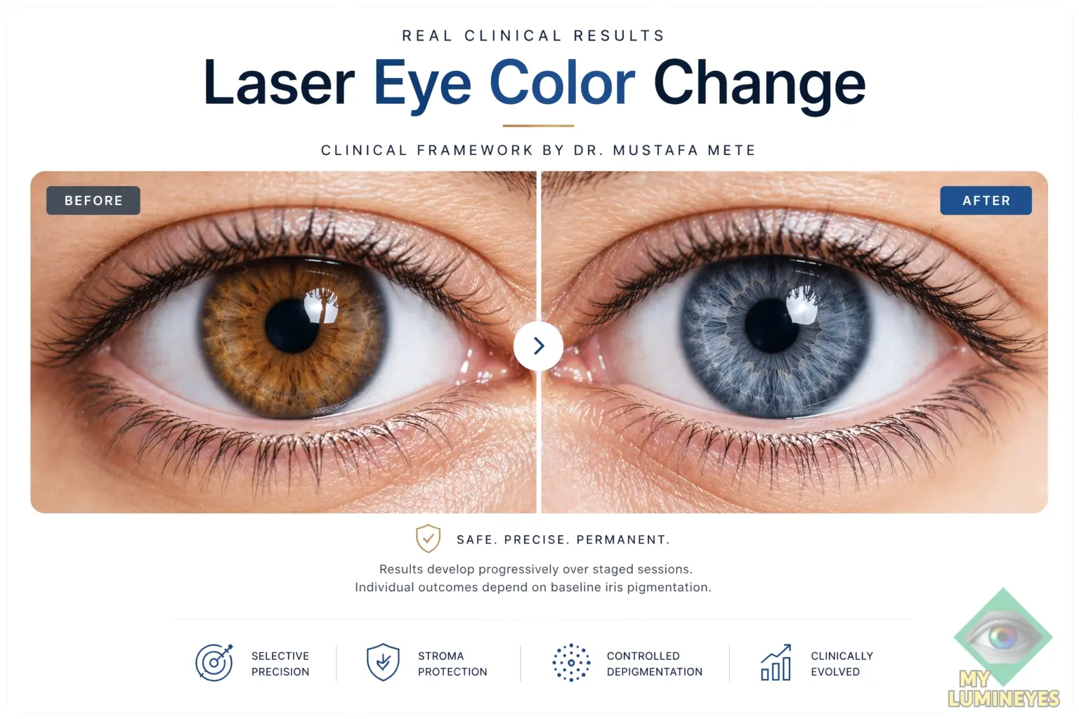 Natural blue eye color change result with Lumineyes 8G Xtra laser technology.