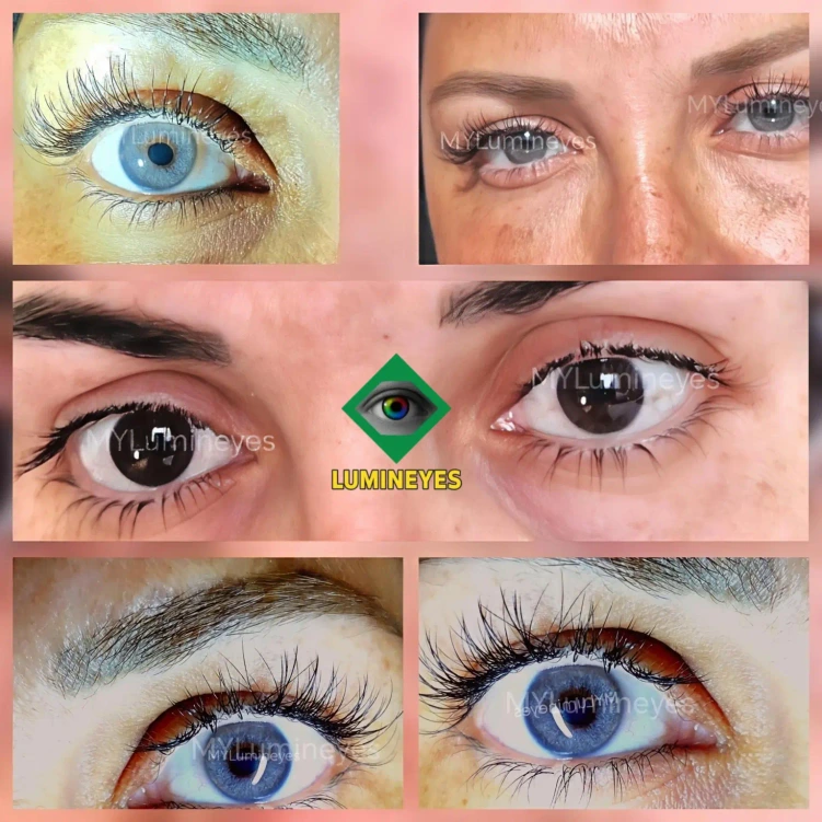 Best laser eye color change results before and after depigmentation process