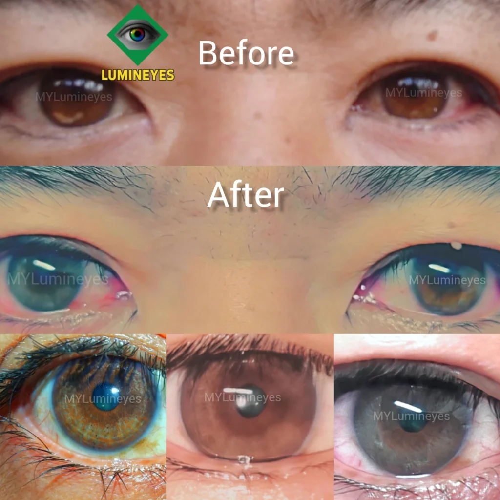 Longitudinal before and after clinical progression of a single patient, demonstrating authentic laser eye color change without surgery. Follow-up images are optimized for clinical clarity.