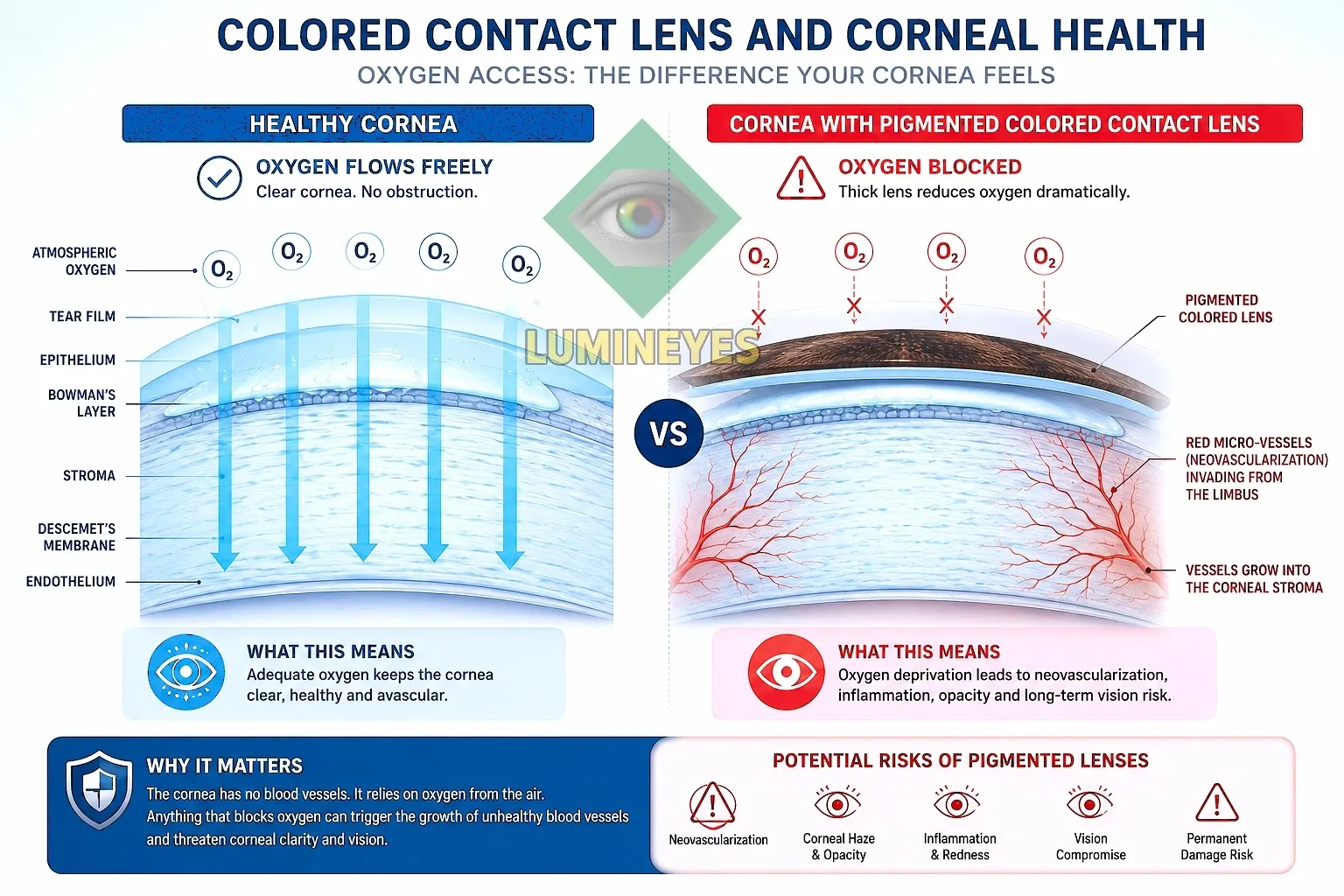 Corneal Hypoxia and Colored Contact Lenses Infographic