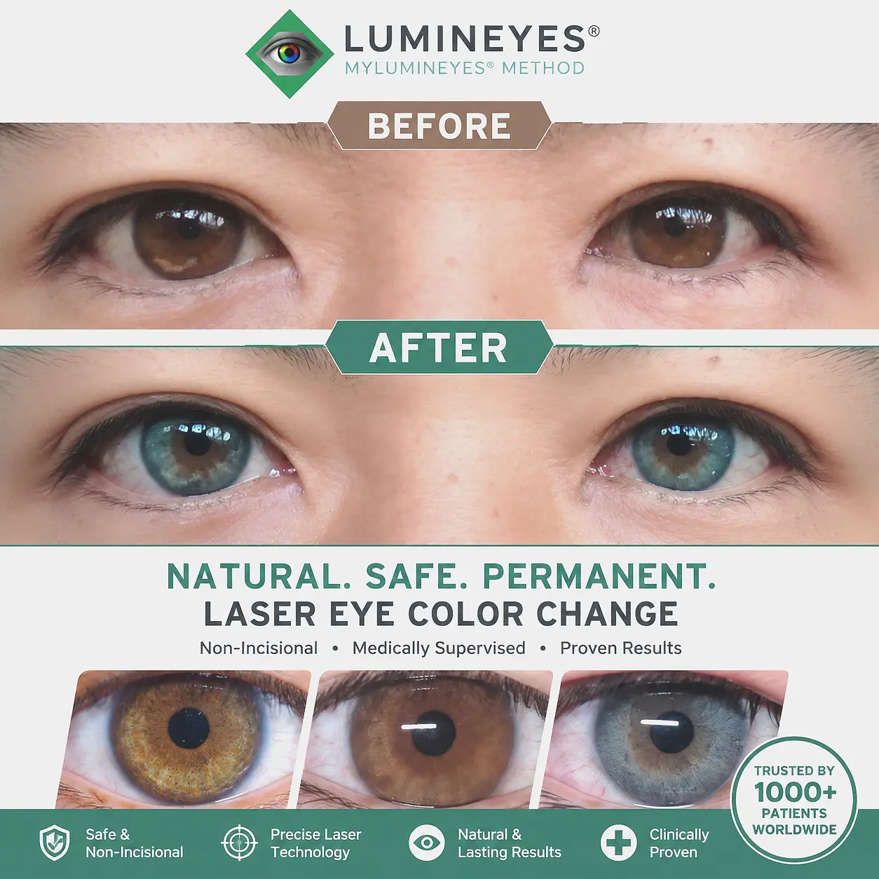 Real patient before and after review of laser eye color change, showing a safe transition from dark brown to natural blue at MyLumineyes.