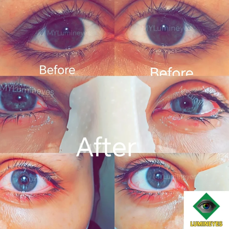 Before-and-after image illustrating staged laser eye color change treatment
