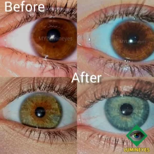 Permanent laser eye color change before and after clinical results, showing a safe biological transition from dark brown to green eyes via MyLumineyes.