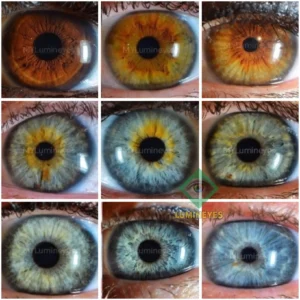 Laser eye color change before and after